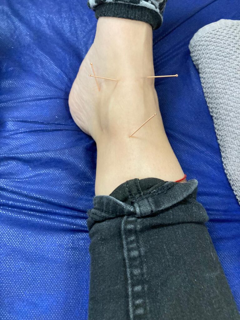 Electro estimulación acupuntura en ibiza